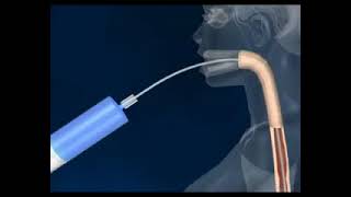 Endoscopic Gastric Balloon  How It Works [upl. by Elolcin]