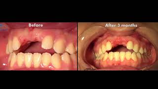 Bone reconstruction in the aesthetic zone using Lateral Augmentation approach [upl. by Carlson593]