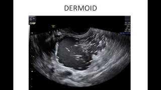 Gynaecology ultrasound of pelvic adnexal masses using IOTA criteria [upl. by Sloan]