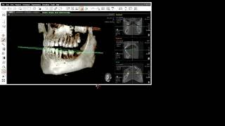 TOMOGRAFIA Diente retenido Ez3D Plus 2024 ODONTO [upl. by Nimesay936]