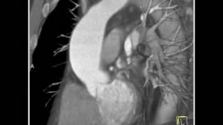 Cardiac Dilated ascending aorta 3 of 3 [upl. by Heng]