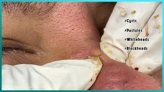 Big Cystic Acne Blackheads Extraction Blackheads amp Milia Whiteheads Removal Pimple Popping [upl. by Ehrenberg]