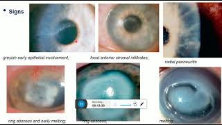 interstitial keratitis cogan syndrome acanthamoeba keratitis [upl. by Maher]