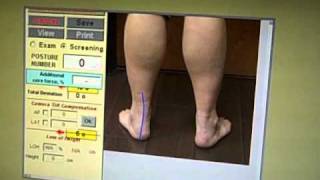 How to Make Custom Foot Orthotics for medial Knee Pain overpronation and Flat Feet [upl. by Mahgem407]