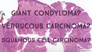 Giant Condyloma vs Squamous Cell Carcinoma vs Verrucous Carcinoma Dermpath Dermatology Pathology [upl. by Lezlie]