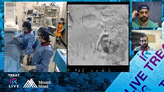 Transradial Embolization of Multiple Renal Angiomyolipomas using LAVA Liquid Embolic System [upl. by Akkinahs]