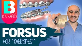 Braces Forsus for Overbite Overjet Correction [upl. by Harris]