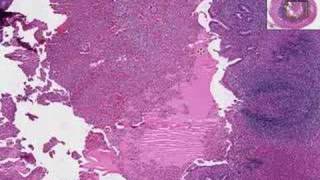 Histopathology Acute Appendicitis [upl. by Oicnanev]