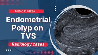 Endometrial Polyp on Transvaginal ultrasound  Radiology case 6 [upl. by Enitsahc334]