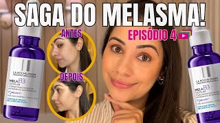 Testando o MELA B3 da La Roche Resultados em 14 Dias  Saga do Melasma Ep 4 [upl. by Manvell]