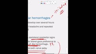 Intracerebral Hemorrhage  Part 3 [upl. by Grishilde]