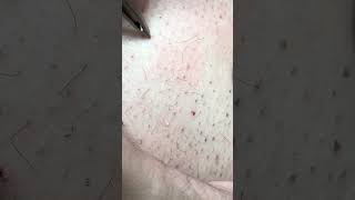 Ingrown back hairs removed part 2 [upl. by Lavella]