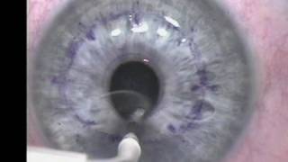 Conductive Keratoplasty [upl. by Tsirc]