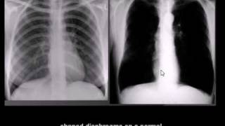 Chest xray interpretation COPD emphysema [upl. by March719]