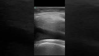 61F lipohemarthrosis from knee tibial plateau fracture and arthrocentesis ApacheUltrasound [upl. by Thaddaus827]