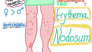 Erythema Nodosum [upl. by Asined486]