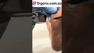 Corn under 5th pma area removal by podiatrist ergonxcomau [upl. by Anivlem946]