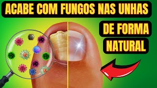 TRUQUES CASEIROS PARA ACABAR COM FUNGOS NAS UNHAS [upl. by Mieka375]