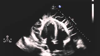 Echocardiogram of a Patient with Uremic Pericarditis [upl. by Kleinstein615]