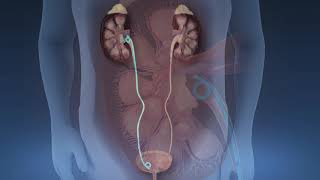 Shockwave Lithotripsy [upl. by Celle718]