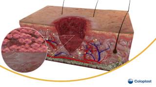 Wound Healing [upl. by Eneirda]