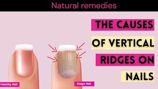 Nail Ridges What Are Your Nails Trying to Tell You [upl. by Dove]