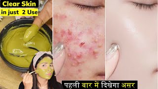 सिर्फ 2 दिन में करे साफ़Whiteheads दाने Oily Skin Bumps PimplesGot Clear Oil Free Skin in 2 Use [upl. by Fey]