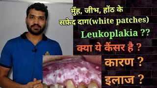 Leukoplakia causes amp treatment  tambaku k karan muh m huye safed dag k karan or ilaj [upl. by Nodnarg]