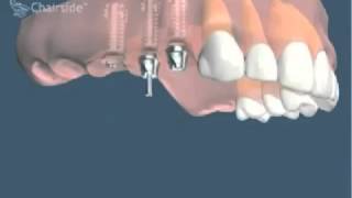 Implants dentaires et bridge sur implants pour remplacer plusieurs dents [upl. by Zuzana330]