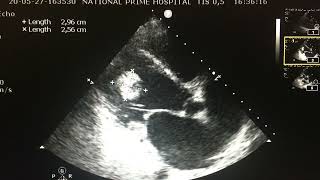 Left ventricular thrombus before and after Warfarin therapy [upl. by Nabe]