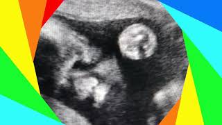 26 weeks pregnant Congenital anomaly scan amp OGTT done [upl. by Adler]