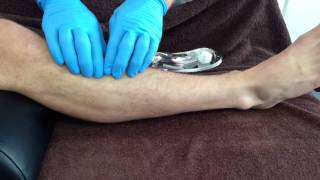 Dry Needling Tibialis Anterior [upl. by Kathleen483]