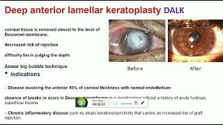 keratoplasty part 2 [upl. by Ahar]