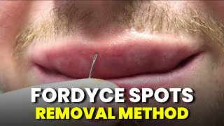 How to remove Fordyce Spots  Fordyce Spots Removal with NEEDLE METHOD Tutorial [upl. by Kcyred606]