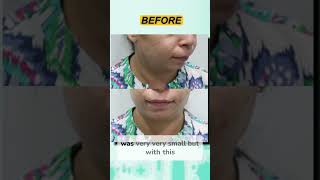 Chin Implants Instant Jawline Upgrade [upl. by Anastassia654]