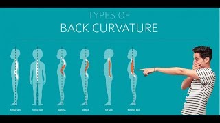 Flatback Syndrome Assessment [upl. by Giustina]