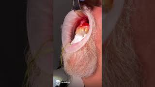 Radicular Cyst Fine Needle Aspiration and Enucleation Large Periapical Cyst in Maxilla [upl. by Mclyman724]