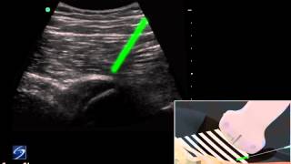 How To Hip UltrasoundGuided Injection of the Proximal Hamstring 3D Video [upl. by Janeen]