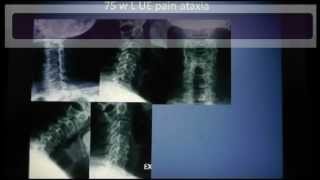 Spine Lecture Anterior Cervical Discectomy and Fusion ACDF [upl. by Portwine]