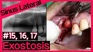 Online Surgery Sinus graft using LAS KIT amp Excision of bony exostosis [upl. by Uos179]