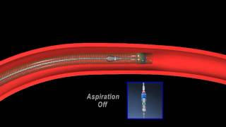 Thrombectomy animation [upl. by Creight]