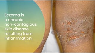 Treating and Managing Eczema in All Skin of Colors [upl. by Reiners]