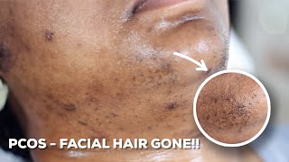 HOW TO WAX YOUR CHIN HAIR AT HOME  DIY Sugar Wax Hair Removal Hack [upl. by Gaskin309]