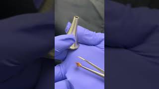 Total earwax blockage removal with microscope and forceps earwaxremoval extractionsatisfaction [upl. by Henning]