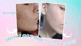 How I got rid of my acne amazing products I used Tesy [upl. by Lamak]