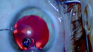 ICL Explantation  Senile Cataract  Nanolaser  Drmed AmirMobarez Parasta  MUNICH EYE [upl. by Emorej]