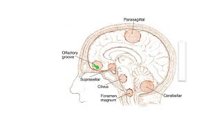 Meningiomas Signs Symptoms and Advanced Treatment Options [upl. by Warp33]