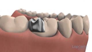 Incrustation  Centres dentaires Lapointe [upl. by Ungley]