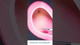 Operative Hysteroscopy  Fibroid amp Polyp removal  Hysteroscopic polypectomy  Types of Hysteroscope [upl. by Eirok2]