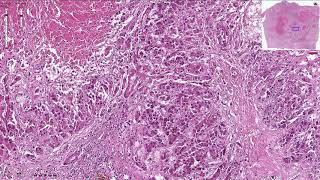 Hepatocellular Carcinoma  Histopathology [upl. by Odette]